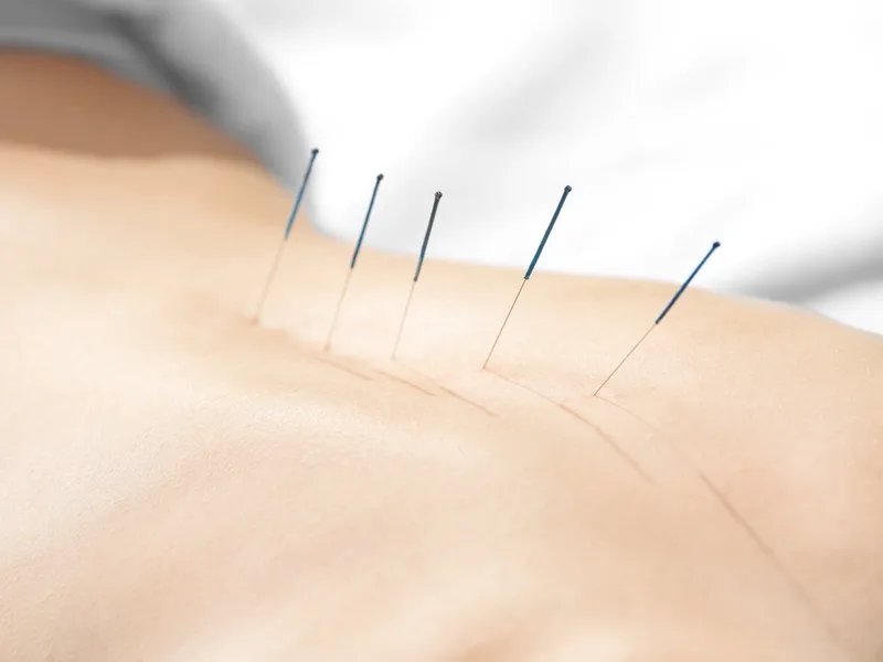 Acupuncture at True North Chiropractic Center in Thief River Falls