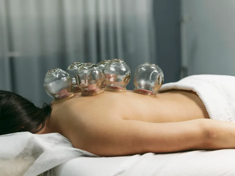 Cupping Therapy at True North Chiropractic Center in Thief River Falls
