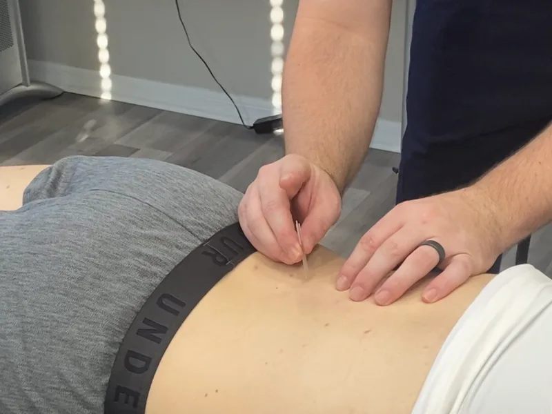 How Dry Needling works at True North Chiropractic Center