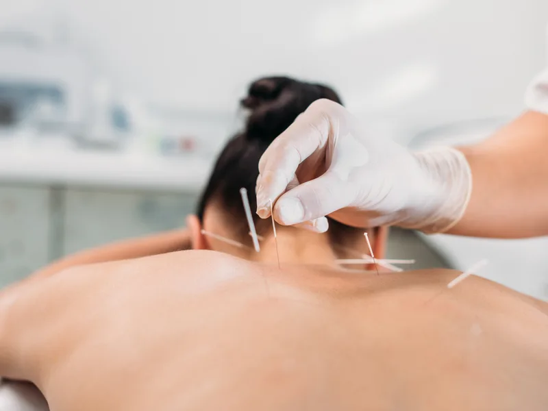 Dry Needling at True North Chiropractic Center in Thief River Falls